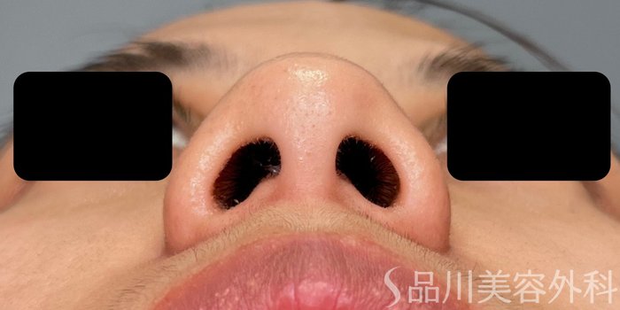 症例NO.72340のBEFORE写真