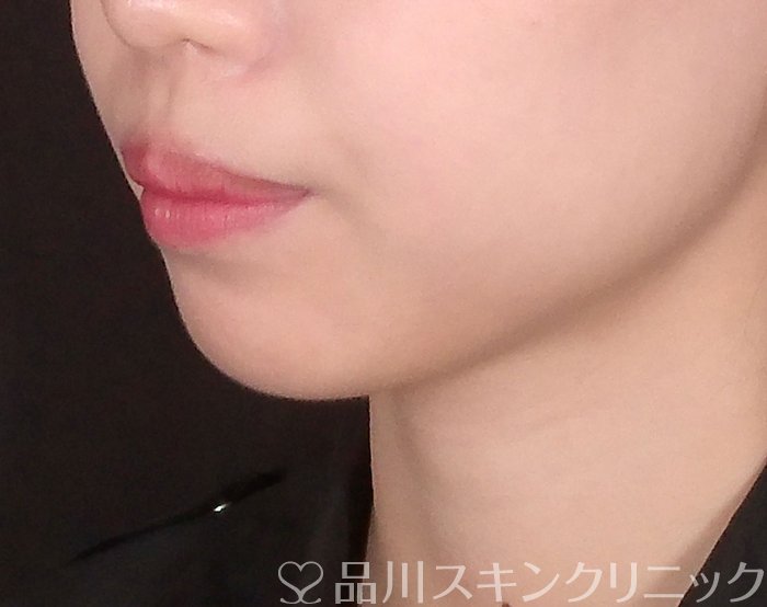 症例NO.69977のBEFORE写真
