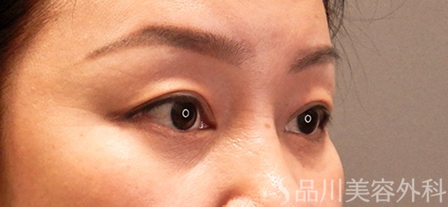 症例NO.70675のBEFORE写真
