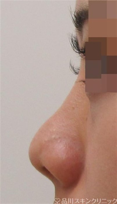 症例NO.40558のBEFORE写真