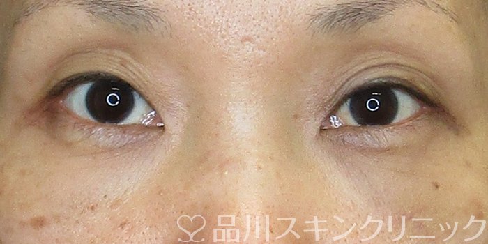 症例NO.74839のAFTER写真