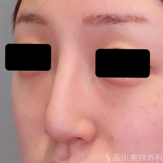 症例NO.47593のAFTER写真