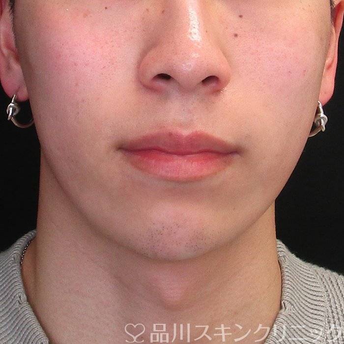 症例NO.73728のAFTER写真