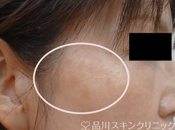 症例NO.44259のBEFORE写真