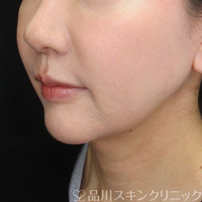 症例NO.72874のBEFORE写真