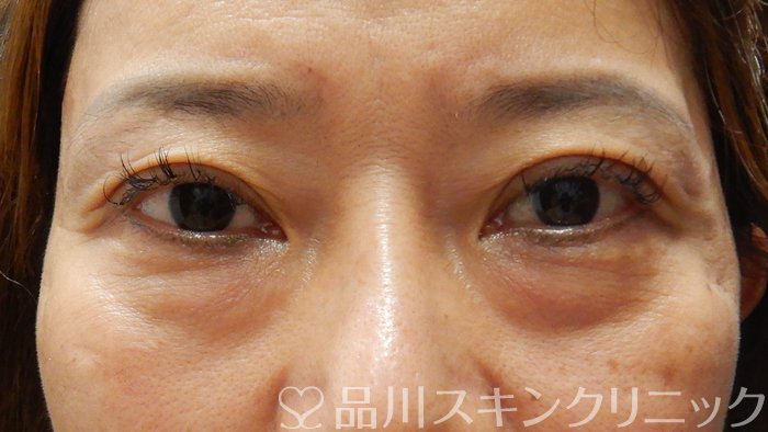 症例NO.62459のBEFORE写真