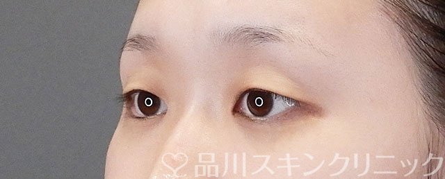症例NO.75272のBEFORE写真