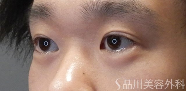 症例NO.64168のAFTER写真