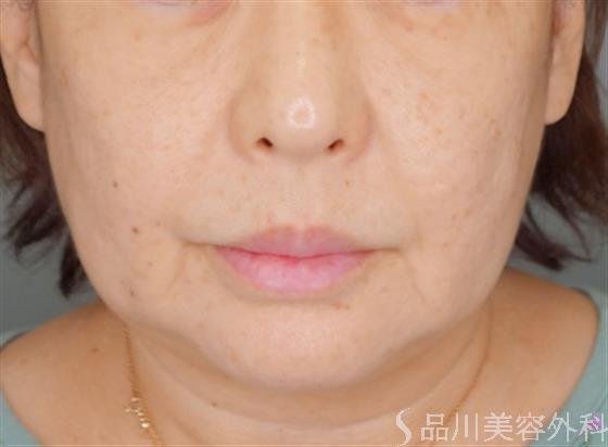 症例NO.53041のBEFORE写真