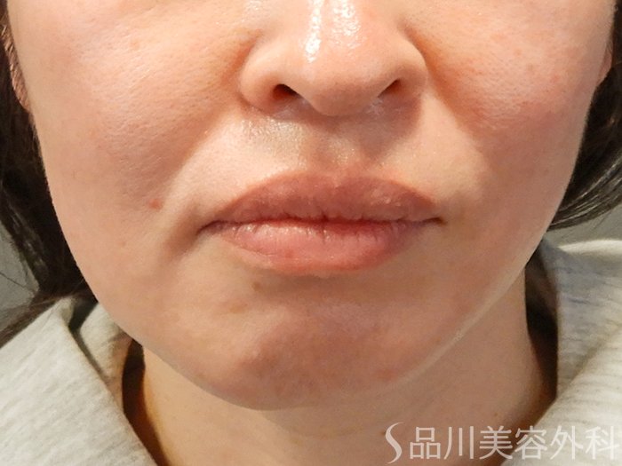 症例NO.69537のBEFORE写真