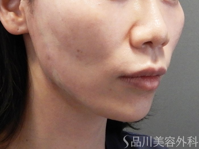 症例NO.70425のAFTER写真