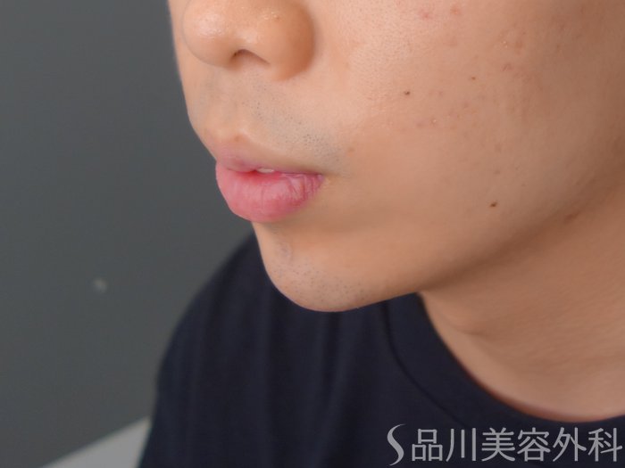症例NO.70261のAFTER写真