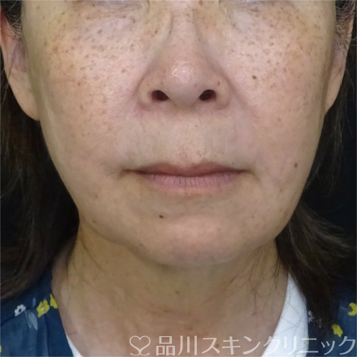 症例NO.71172のAFTER写真