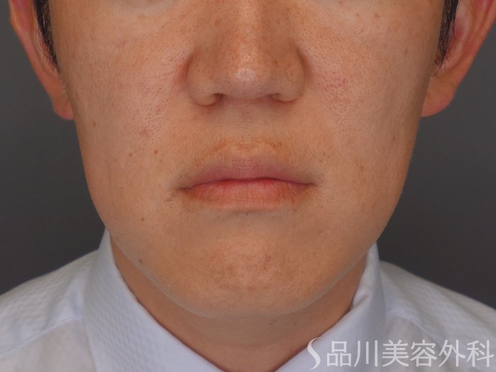 症例NO.67817のBEFORE写真