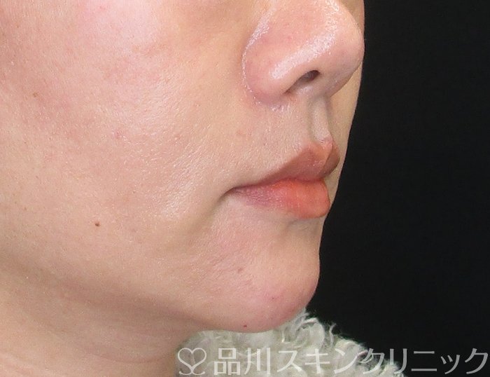 症例NO.73211のAFTER写真