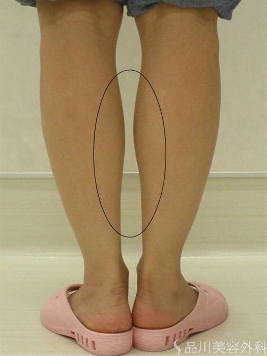 症例NO.42057のBEFORE写真