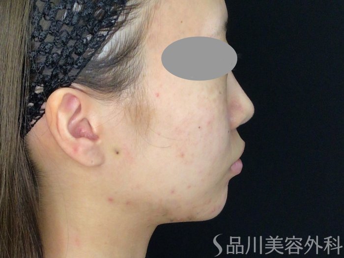 症例NO.71827のBEFORE写真