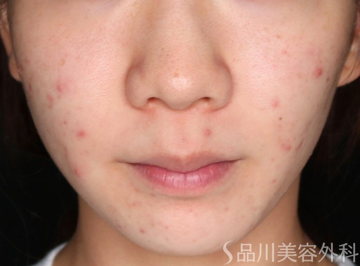 症例NO.73597のBEFORE写真