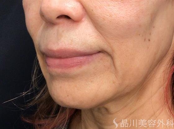症例NO.59174のBEFORE写真
