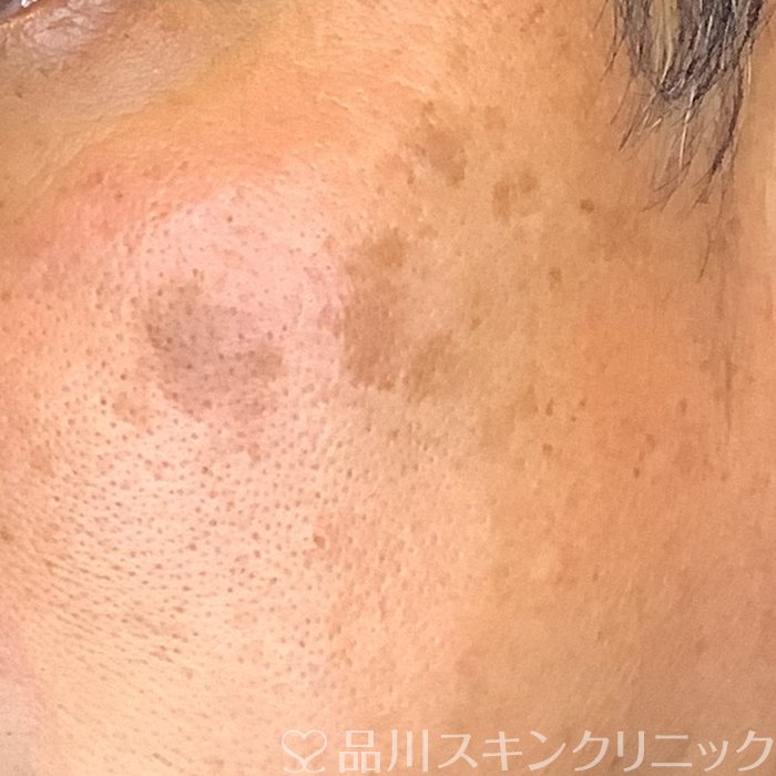 症例NO.72978のBEFORE写真