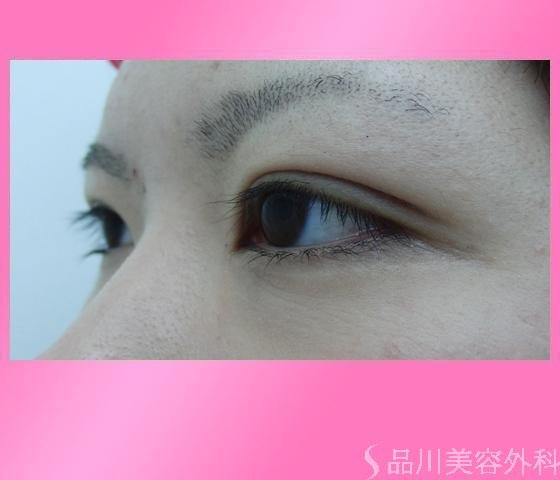 症例NO.4087のAFTER写真