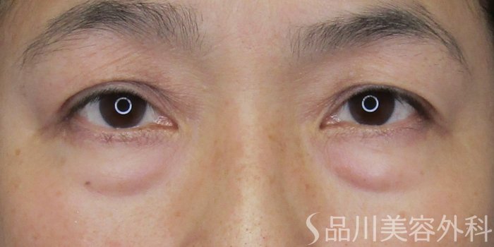症例NO.75136のBEFORE写真