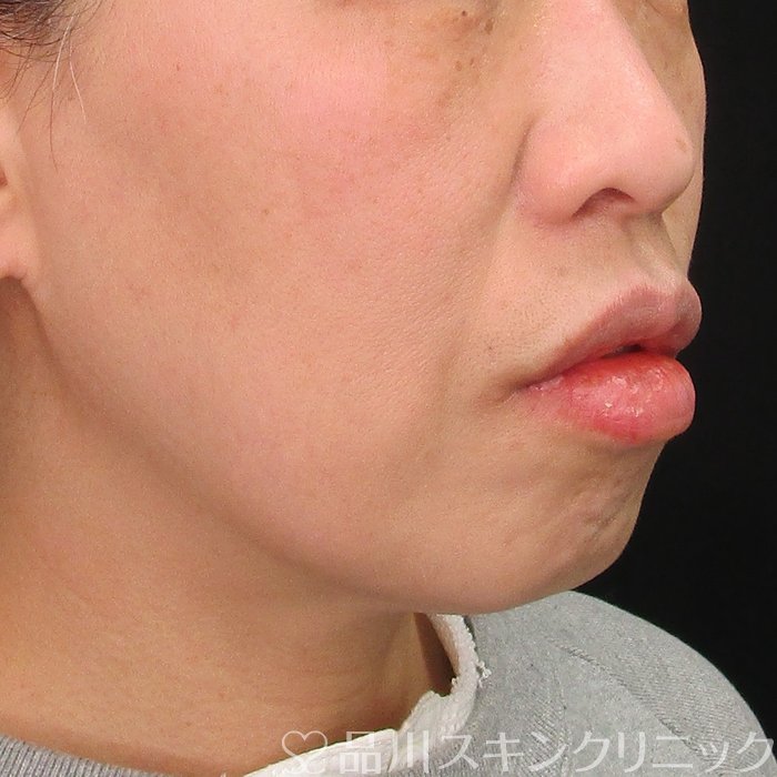 症例NO.73981のBEFORE写真