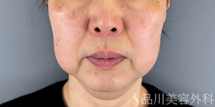 症例NO.70790のBEFORE写真