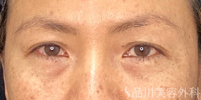 症例NO.73041のBEFORE写真