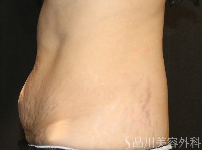 症例NO.72638のAFTER写真