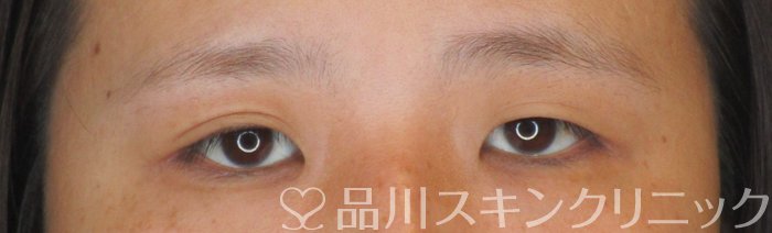 症例NO.64312のBEFORE写真