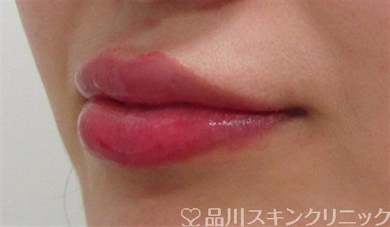 症例NO.31539のAFTER写真