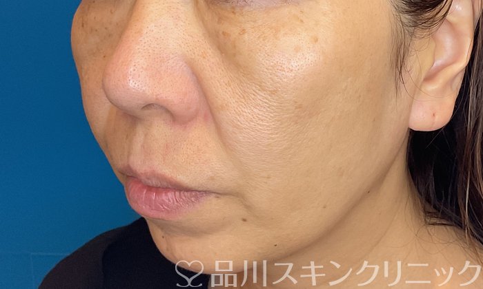 症例NO.73791のBEFORE写真