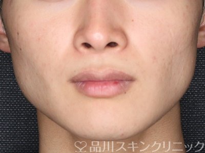 症例NO.74178のAFTER写真