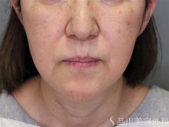 症例NO.48568のBEFORE写真