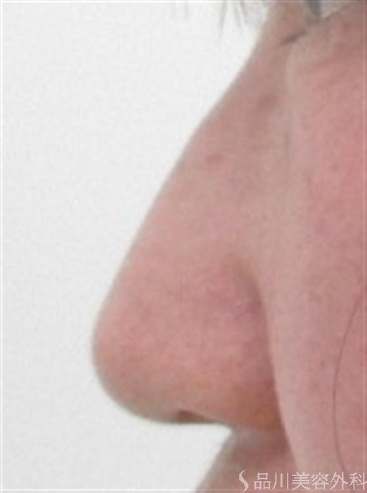 症例NO.16528のBEFORE写真