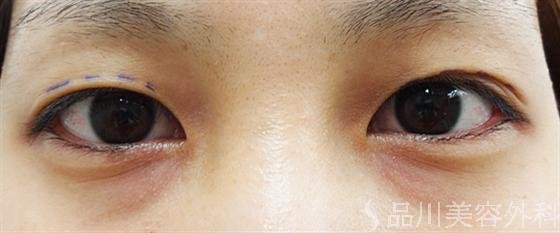症例NO.14155のBEFORE写真