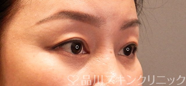 症例NO.70675のBEFORE写真