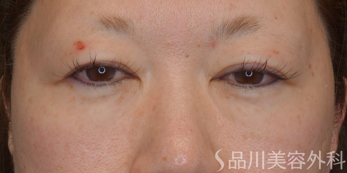 症例NO.73036のBEFORE写真