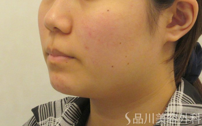 症例NO.71710のAFTER写真