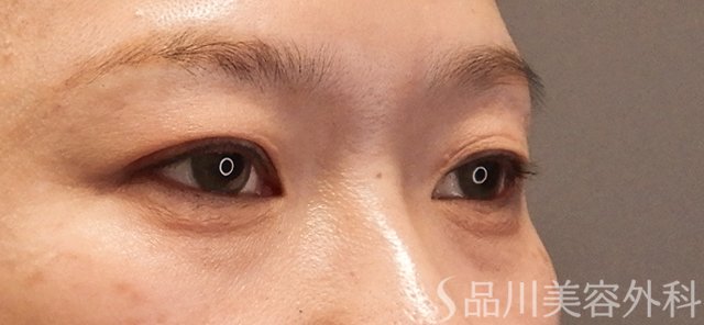 症例NO.72767のBEFORE写真