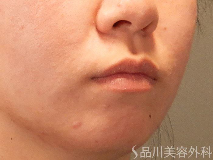 症例NO.70127のBEFORE写真