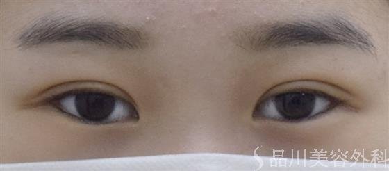 症例NO.52259のAFTER写真