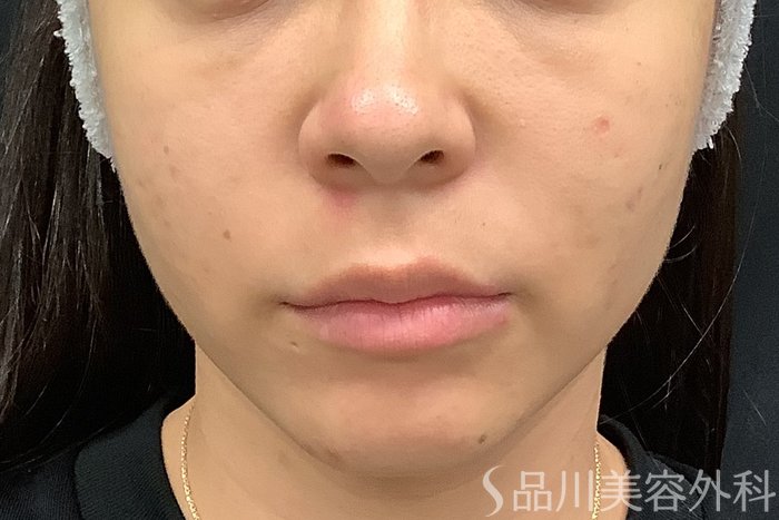 症例NO.67803のBEFORE写真