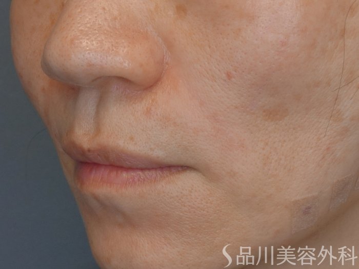 症例NO.72892のAFTER写真