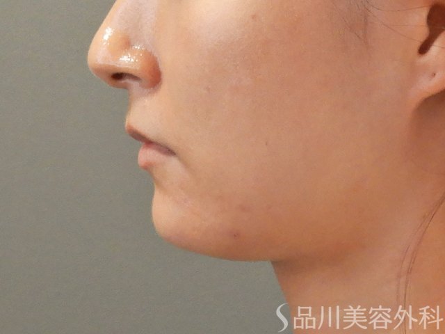 症例NO.71816のAFTER写真