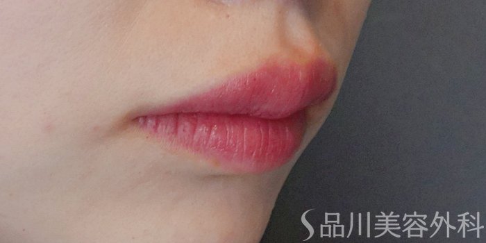 症例NO.72045のAFTER写真