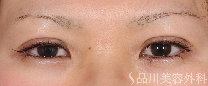 症例NO.73237のAFTER写真