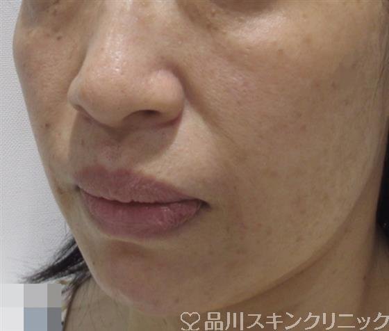 症例NO.38247のAFTER写真