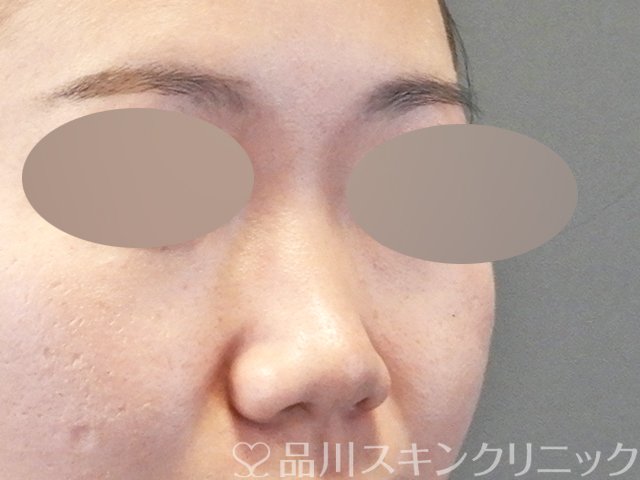 症例NO.65424のBEFORE写真